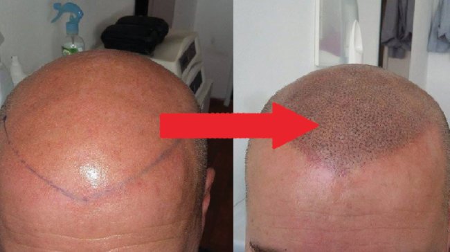 Tetování vlasů aneb Když je lví hříva minulostí...